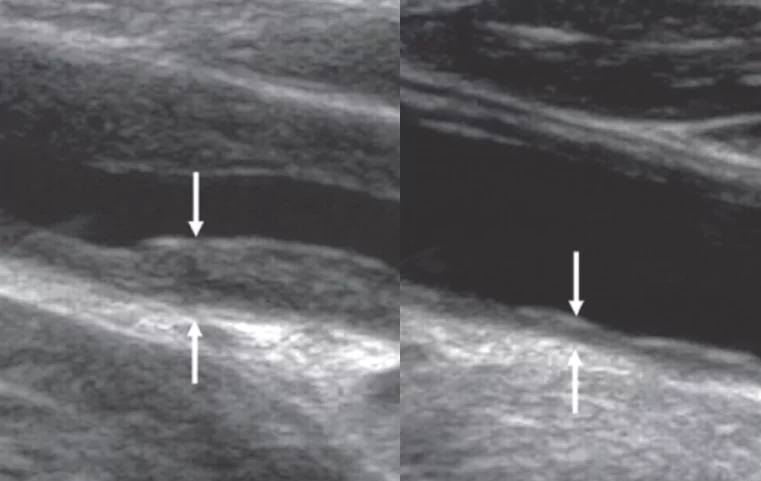 O comparație a unor secțiuni transversale a vaselor mele de sânge, înainte și după 4 săptămâni de testare