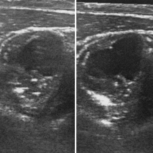 Anna din Făgăraș și arterele ei deblocate