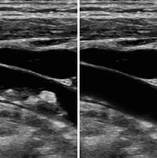 Efectul de descompunere a plăcii lipidice la Jean din Craiova