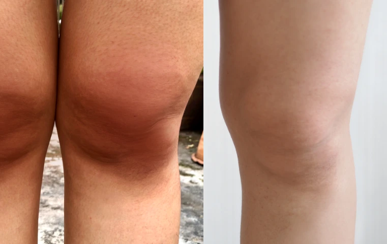 Oto ja przed kuracją i 4 tygodnie po rozpoczęciu kuracji