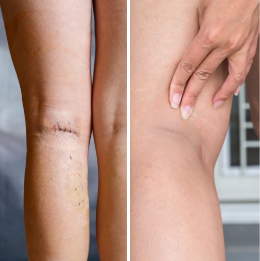 Dagmara: noga po złamaniu jest silniejsza niż przed wypadkiem