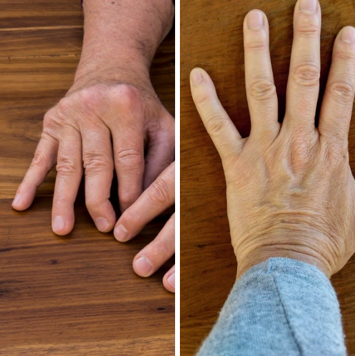 Jarek z Kołobrzegu: zmiany reumatoidalne na rękach cofnęły się w 98%