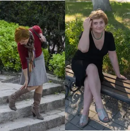 Manuela: se deshizo de la hinchazón y las arañas vasculares azules que cubrían sus piernas