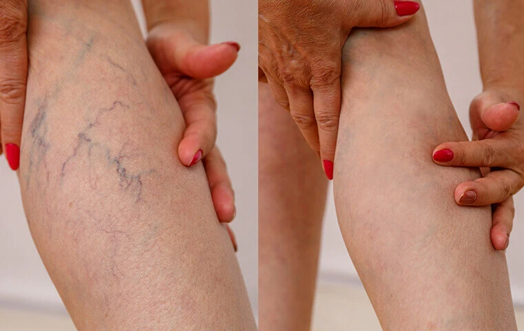  Queste sono le mie gambe prima del test e dopo 3 settimane di utilizzo del gel