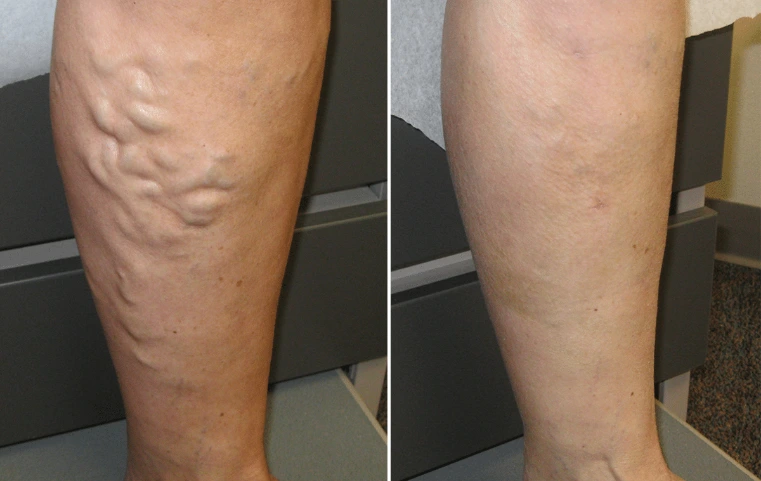 Voici mes jambes avant les tests et 2 semaines après avoir commencé la cure