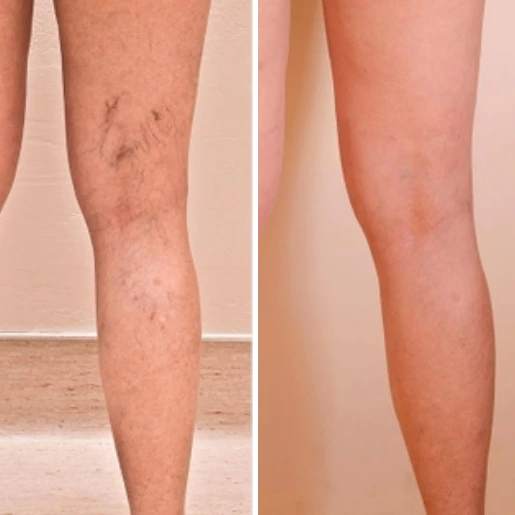 Patricia de Lille : les veines violettes ont disparu à 99%