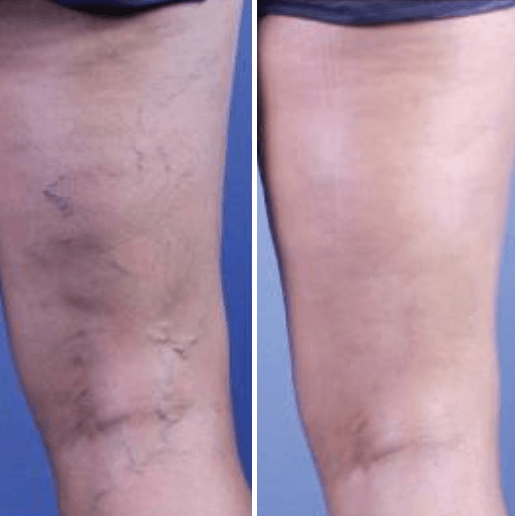 Janina: koniec z pajączkami!