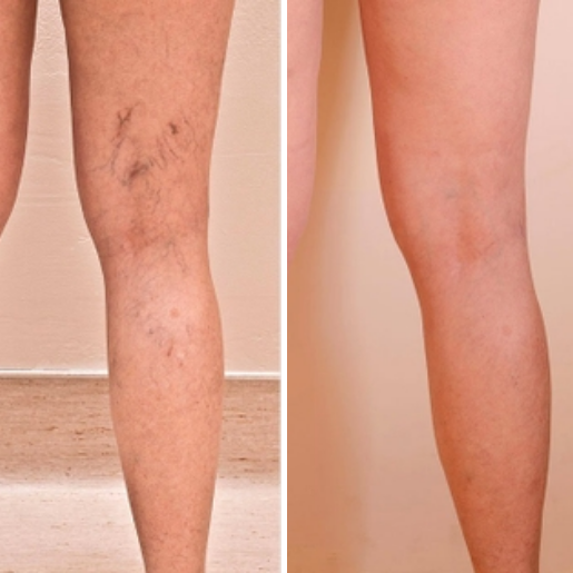 Edyta z Gniezna: sine żylaki siatkowate zaniknęły w 99%